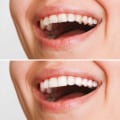 Understanding Veneers and Bonding: A Comprehensive Guide to Cosmetic Dentistry