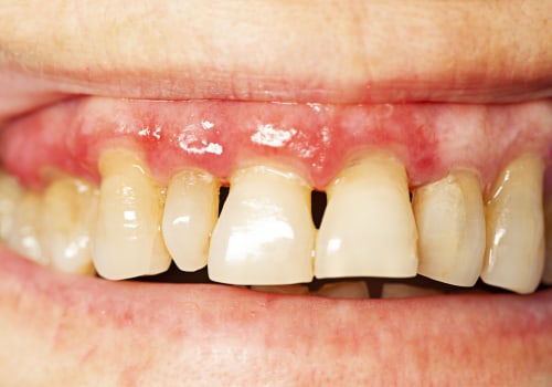 Symptoms of Gum Disease: Recognizing and Treating This Common Dental Issue