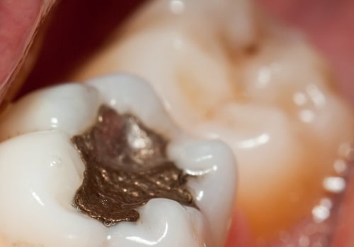 Types of Fillings: Understanding Your Dental Restorative Options